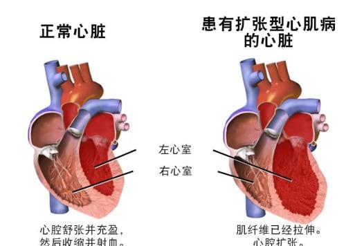 扩张性心肌病严重吗