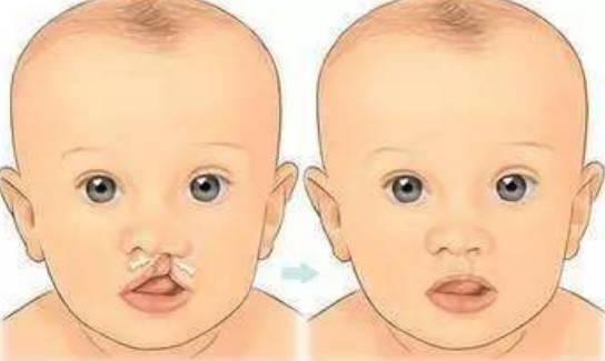 宝宝是否适合做唇腭裂手术、挂什么科？