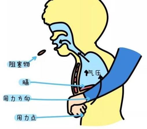 食物卡住喉咙的急救方法