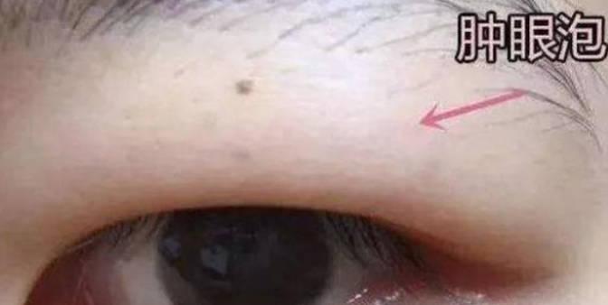 手术消除肿眼泡做完要多久时间？