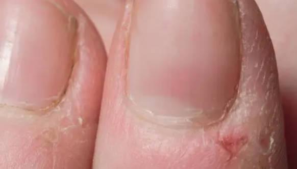 该如何预防手指干燥生出倒刺?