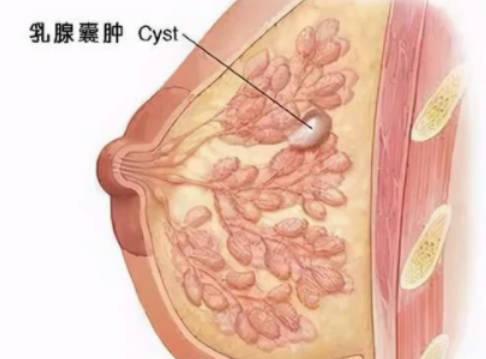 哺乳期乳腺囊肿怎么办？