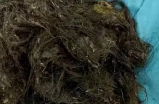 女孩吃头发胃里取出5斤毛球