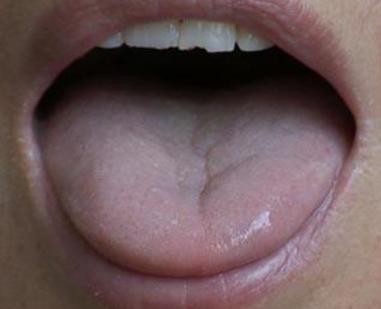 舌头有裂纹是怎么回事吃什么药