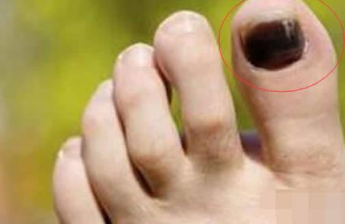 脚趾甲被砸到紫黑色大概多久恢复？