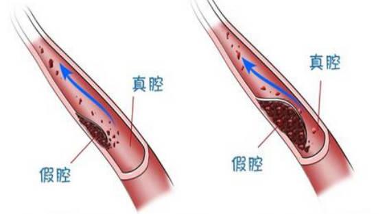 血管夹层是什么病？