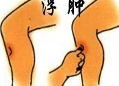 怎样判断自己是不是水肿？