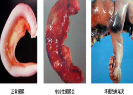 阑尾感染的原因有哪些？
