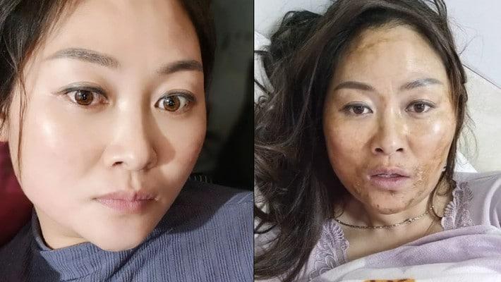 女子感染新冠高烧后满脸发黑