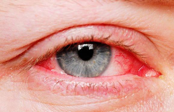 眼眶蜂窝织炎的病因有哪些？