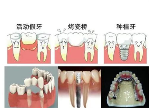 常见的镶牙方法有哪些（烤瓷牙，种植牙等）
