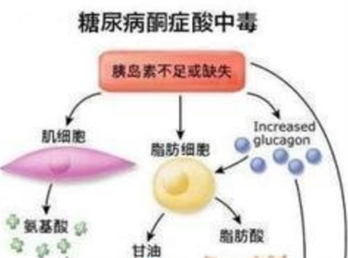 什么是糖尿病酮症酸中毒（糖尿病急性并发症）