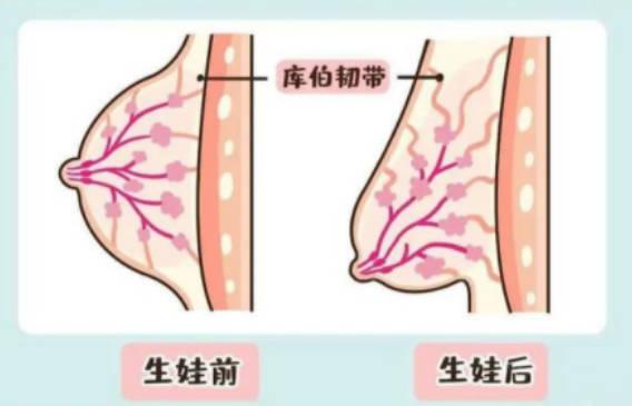 产后胸部下垂怎么办呢（多锻炼）