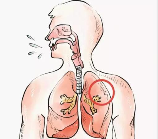 男子不明原因咳嗽半年  原来肺中呛入虾壳