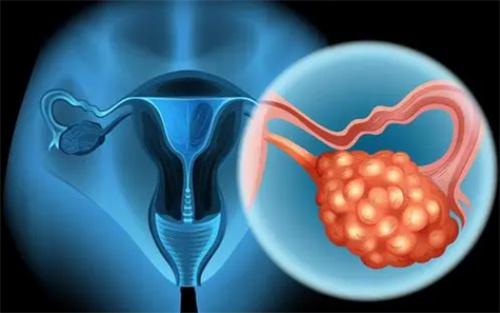2/3卵巢癌患者难以跨越5年生存期 近年来治疗愈加精准化