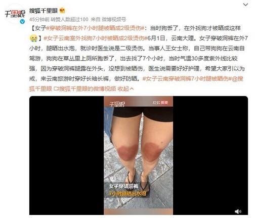 云南女子穿破洞裤7小时腿被晒伤，温度30多度紫外线强烈