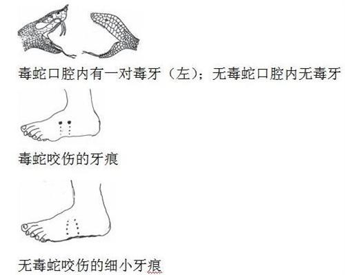 夏季蛇出没频繁 医生提醒：被蛇咬伤记住18字救命要诀