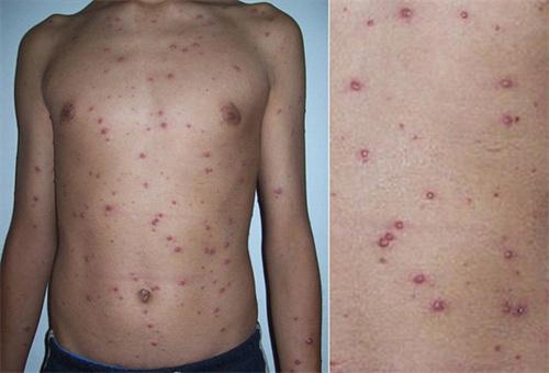 8种常见的感染相关皮疹 你是否会诊断