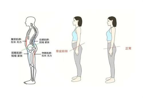 臀部太翘 究竟会有多危险