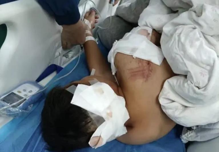 湖南城步10岁男童遭阿拉斯加犬咬伤：ICU救治第三天的故事