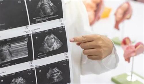 香港一名女子为怀男胎听医生建议后生下2女婴