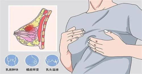 全面了解乳腺癌（关于全面了解乳腺癌的简介）