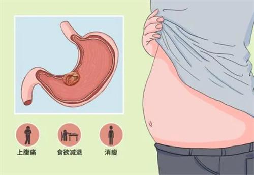 胃癌患者的营养攻略（关于胃癌患者的营养攻略的简介）