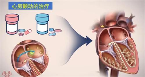 房颤的最佳治疗方法（关于房颤的最佳治疗方法的简介）